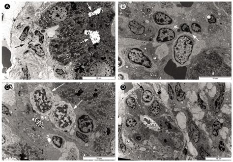 Electron Microscopic Andiysis Of Liver Biopsy Samples From Case 1 A