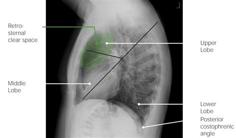 Normal Chest X-ray: Anatomy Tutorial Kenhub, 43% OFF