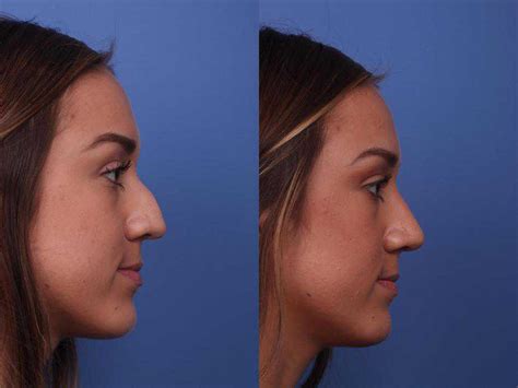 How Much Does A Nose Job Cost Cost Niche