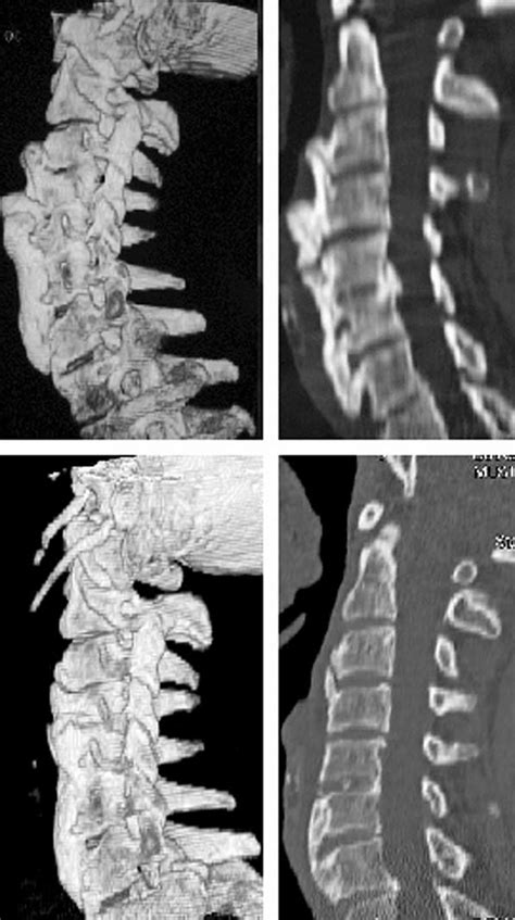 Preoperative D A And Mpr B Ct Displayed Large Bridging Osteophytes