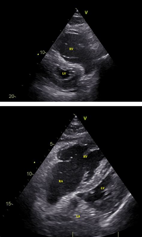 Echocardiography demonstrated massive dilatation of right heart ...