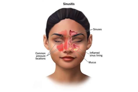 Sinus Problems And Relief During Allergy Season Dr Nishant Ent