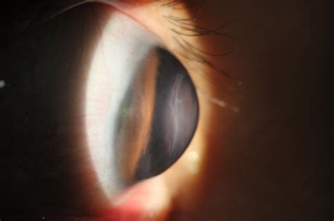 Scleral Lens Rgp Lens Keratoconus Screening Inquiry — Paroli