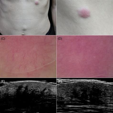 A And B The Patient Presented With Multiple Fleshcolored And