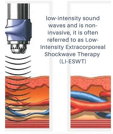 Performance Wave Treatment in SLC | Rising Health Specialty Clinic