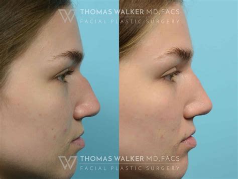 Liquid Rhinoplasty Before And After Photos Atlanta Ga