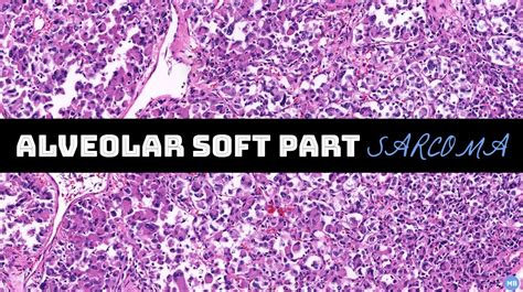 3 THINGS TO KNOW Alveolar Soft Part Sarcoma KiKo XP