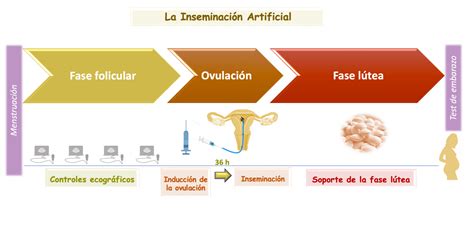 Inseminación artificial con semen de donante Gyneco FIV