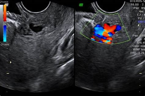 Avm In Cesarean Scar Usg Sumers Radiology Blog