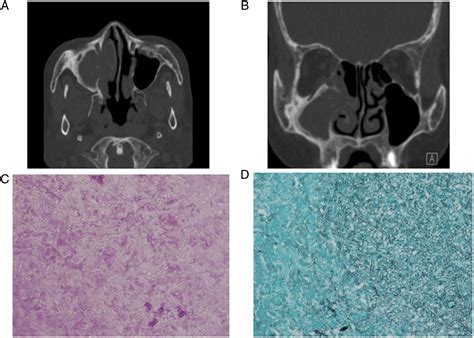 Fibrous Dysplasia Of Maxilla