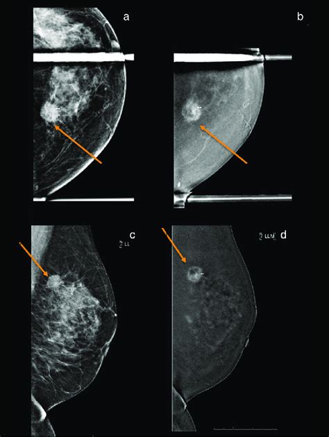 A 49 Year Old Woman With Left Breast Invasive Ductal Cancer Grade 3