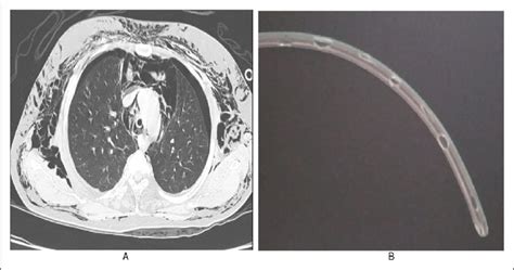 A Chest CT scan showing extensive pneumomediastinum with minimal ...