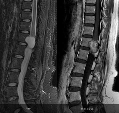 Spinal Schwannoma Image Radiopaedia Org