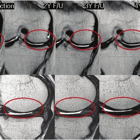 Changes In Cartilage From Baseline Based On Cartilage Defect Area And