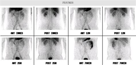 Figure 1 From Angiographic Diagnosis Of Meckels Diverticulum In An