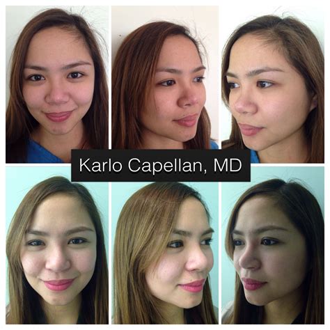 Service Face Symmetry Plastic Surgery Dr Karlo Capellan Md