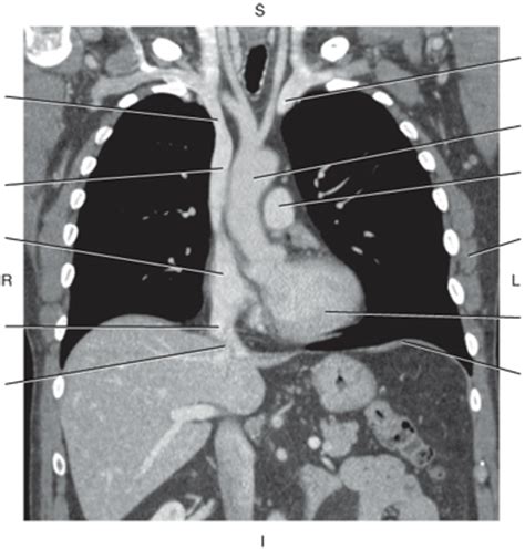 Coronal Ct Diagram Quizlet