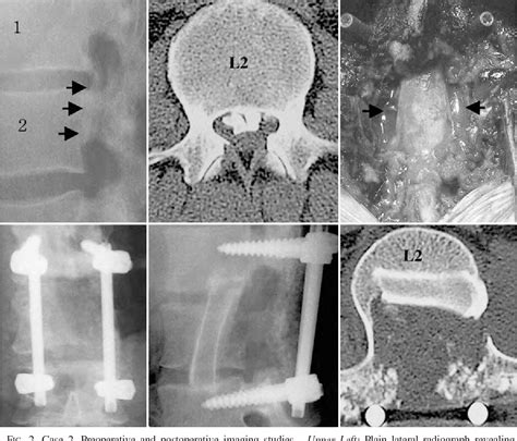 Figure 2 From Surgical Treatment Of Lumbar Ossification Of The