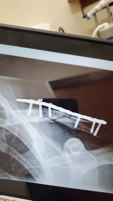 Broken collarbone. So long, you strong boned freaks! : r/Neverbrokeabone