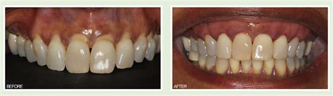 Zirconium Implants Dental Implants Miami Dentist Coral Gables Fl