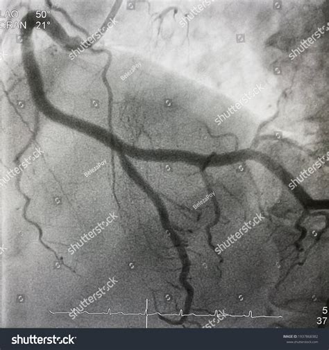 Coronary Angiogram Showed Right Coronary Artery Stock Photo (Edit Now ...