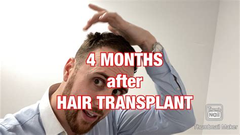 MONTH 4 After FUE Hair Transplant In Istanbul Turkey 3500 Grafts