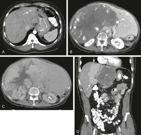 Benign Tumors Of The Liver Radiology Key