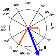 Heart Axis Calculation