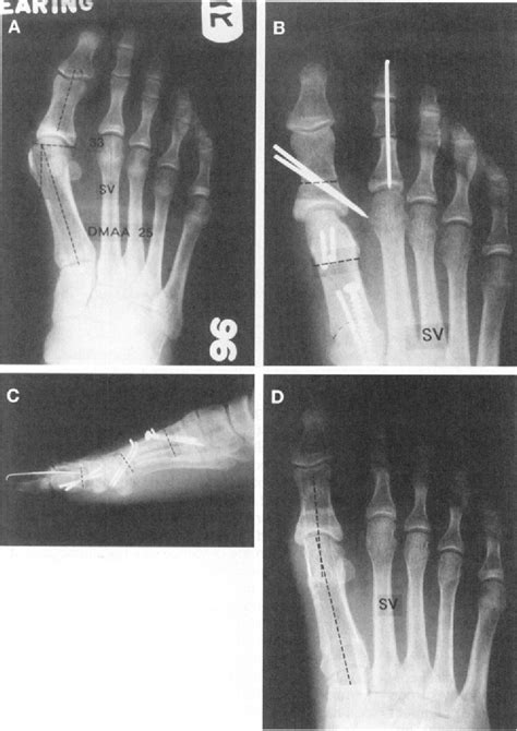 Figure From Treatment Of Hallux Valgus With An Increased Distal