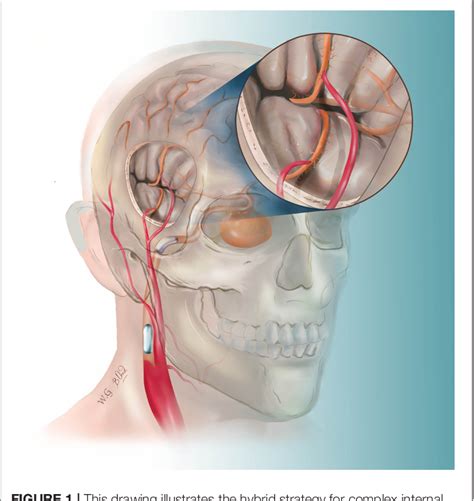 Figure 1 From A Hybrid Strategy For Patients With Complex Cerebral