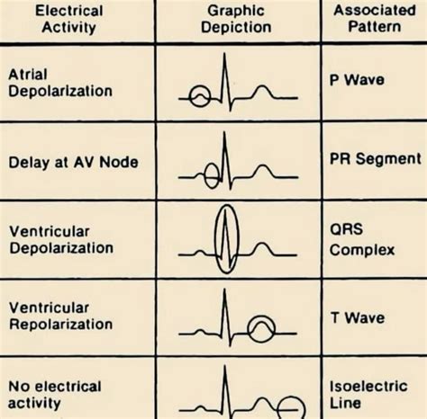 Ecg interpretation review 13 bbb wide qrs is this lbbb vs rbbb vs ivcd ...