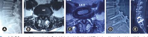 Figure 2 From Contralateral Lower Limb Radiculopathy Following