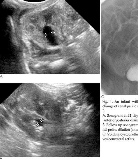 Figure 1 From Clinical Significance Of Renal Pelvic Dilatation Less