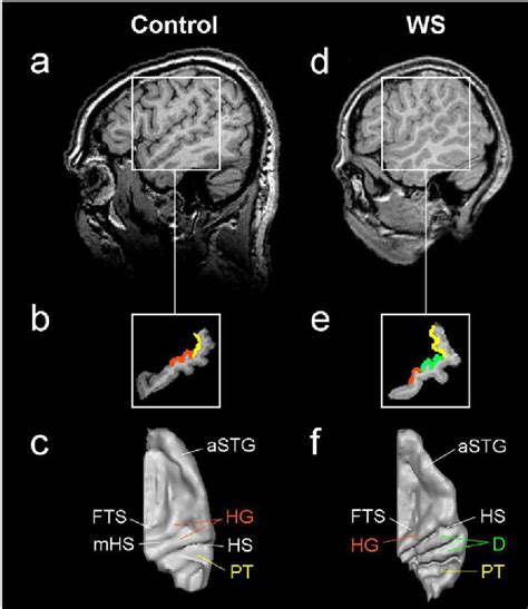 Anatomical landmarks of the auditory cortex. Auditory cortex (AC) of ...