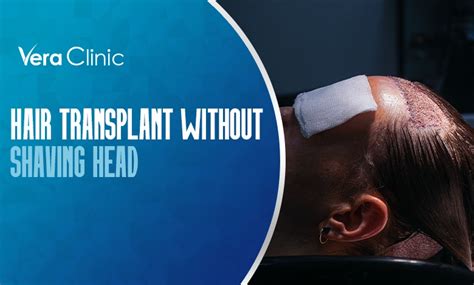 Hair Transplant Without Shaving Head Vera Clinic