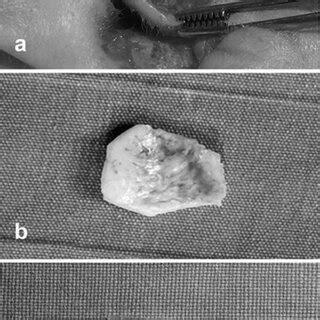 A Dissection Of Tragal Cartilage While Leaving A Strip B