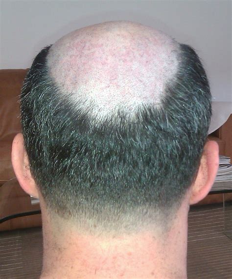 Pin By Hank Hudson On Balding Male Pattern Baldness Bald Men Style Hot Haircuts