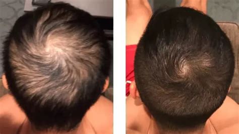 Minoxidil Before And After Photos [2022] Is It Right For You