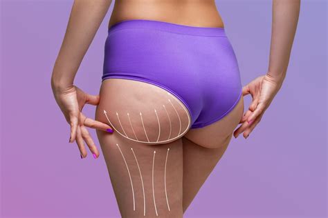 Sculptra Non Surgical Butt Lift Treatment In Beverly Hills Ca Onsite