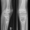 Bone cyst causes, symptoms, diagnosis, treatment & prognosis