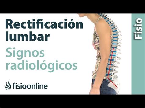 Rectificaci N Lumbar Signos Radiol Gicos Youtube