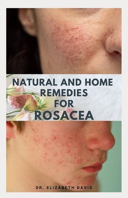 Natural And Home Remedies For Rosacea A Self Help Guide To Completely