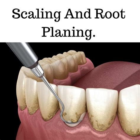 Scaling And Root Planing What You Need To Know The Dental Bond