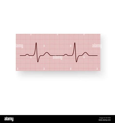 Frecuencia Cardíaca O Un Latido En Un Papel De Trazado Electrocardiograma Realizado Del Corazón