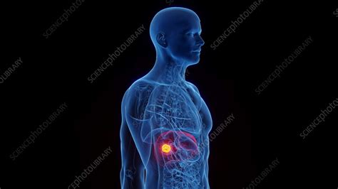 Animation of hepatic carcinoma in a man - Stock Video Clip - K012/0844 ...