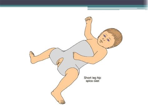 Plaster of paris ,synthetic casts and Functional cast bracing | PPT