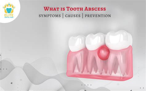 What Are Tooth Abscess Symptoms Causes And Prevention Elite Dental Care