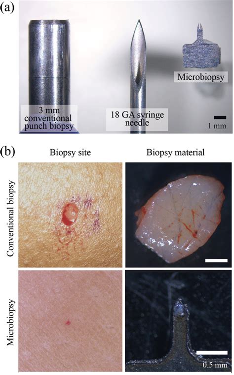 View 12 Skin Punch Biopsy Scar - zenidrat