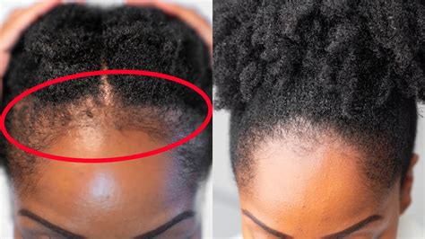 GROW Back Your EDGES FASTER With These 5 SIMPLE Tips YouTube