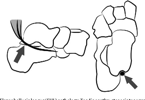 Figure 1 From The Management Of Posterior Ankle Impingement Syndrome In